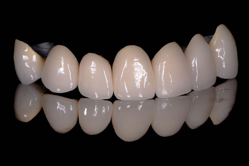 metal-ceramic-1