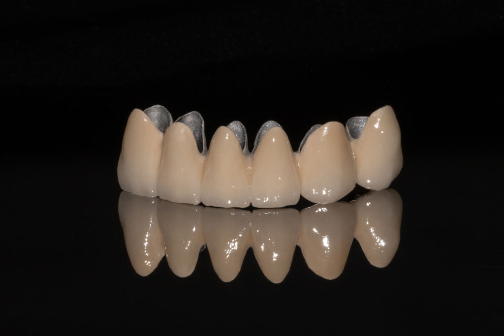 metal-ceramic-3